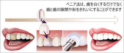ラミネートベニア法